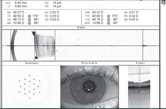 calculo de lente intraocular 3