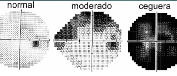 campos visuales computarizados (1)