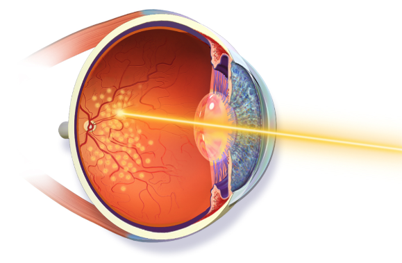 laser argon (1)