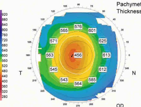 paquimetria (3)