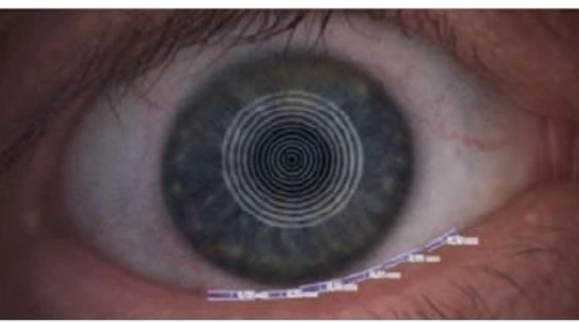 tear analysis (2)
