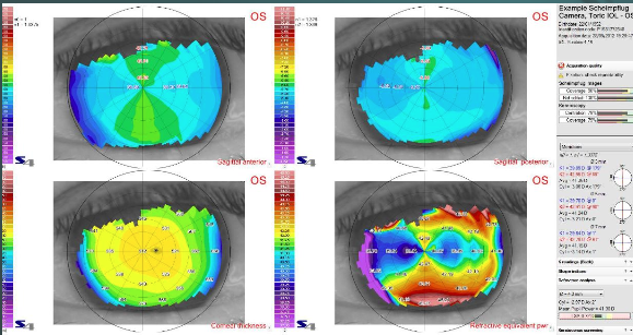 topografia corneal (1)