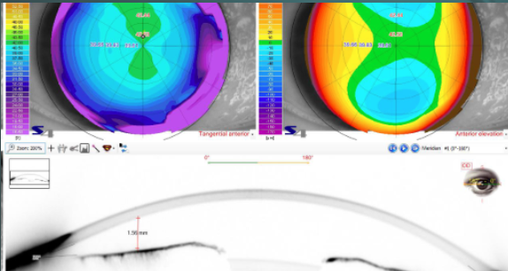 topografia corneal (2)