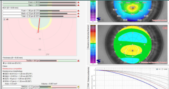 topografia corneal (3)